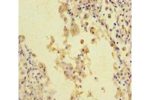 Immunohistochemistry of paraffin-embedded human lung cancer using ABIN7168626 at dilution of 1:100 (STIL anticorps  (AA 388-637))