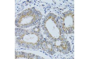 Immunohistochemistry of paraffin-embedded human colon carcinoma using DNAJC19 antibody. (DNAJC19 anticorps)