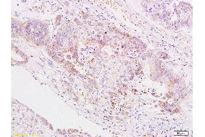 Formalin-fixed and paraffin embedded human gastric carcinoma labeled Anti-B7H4 Polyclonal Antibody, Unconjugated  at 1:200, followed by conjugation to the secondary antibody and DAB staining