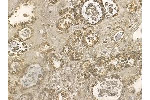 PLCG2 Mouse Monoclonal Antibody at 1/100 staining human ovarian cancer by IHC-P. (Phospholipase C gamma 2 anticorps  (C-Term))
