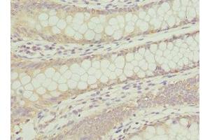 Immunohistochemistry of paraffin-embedded human colon cancer using ABIN7144072 at dilution of 1:100 (ANAPC2 anticorps  (AA 1-230))