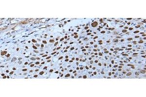 Immunohistochemistry of paraffin-embedded Human lung cancer tissue using ZNHIT3 Polyclonal Antibody at dilution of 1:80(x200) (ZNHIT3 anticorps)
