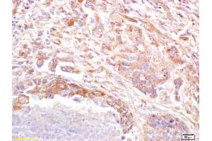 Formalin-fixed and paraffin embedded human lung carcinoma labeled with Anti PRSS8 Polyclonal Antibody (ABIN761891), Unconjugated at 1:200, followed by conjugation to the secondary antibody and DAB staining (PRSS8 anticorps  (AA 65-165))
