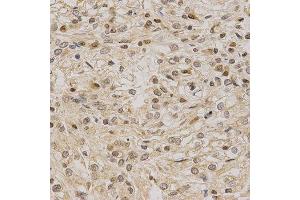 Immunohistochemistry of paraffin-embedded human kidney cancer using LETMD1 antibody at dilution of 1:200 (x400 lens) (LETMD1 anticorps  (AA 161-360))