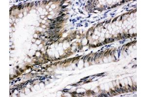 Anti-STAT6 antibody, IHC(P) IHC(P): Human Intestinal Cancer Tissue