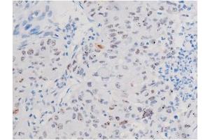 ABIN6267503 at 1/200 staining Human lung cancer tissue sections by IHC-P.