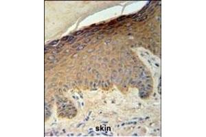 KRT35 Antibody (C-term) (ABIN651184 and ABIN2840116) IHC analysis in formalin fixed and paraffin embedded skin carcinoma followed by peroxidase conjugation of the secondary antibody and DAB staining. (Keratin 35 anticorps  (C-Term))