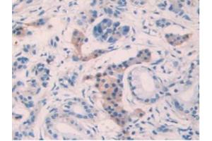 IHC-P analysis of Human Pancreas Cancer Tissue, with DAB staining.