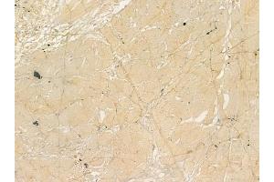 ABIN6260975 and ABIN6273213 at 1/100 staining human tongue carcinoma by IHC-P.