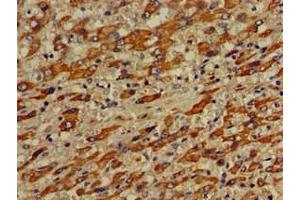 Immunohistochemistry of paraffin-embedded human liver cancer using ABIN7175308 at dilution of 1:100 (VPS33A anticorps  (AA 1-300))