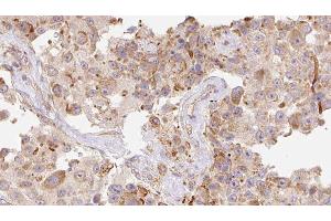 ABIN6277922 at 1/100 staining Human Melanoma tissue by IHC-P. (Cathelicidin anticorps  (Internal Region))