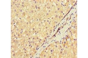 Immunohistochemistry of paraffin-embedded human liver cancer using ABIN7169570 at dilution of 1:100 (NEU1 anticorps  (AA 201-415))