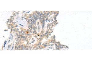 Immunohistochemistry of paraffin-embedded Human ovarian cancer tissue using CAMK2A Polyclonal Antibody at dilution of 1:55(x200) (CAMK2A anticorps)