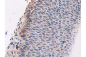 Detection of CECR1 in Human Skin cancer Tissue using Polyclonal Antibody to Cat Eye Syndrome Chromosome Region, Candidate 1 (CECR1) (CECR1 anticorps  (AA 30-511))