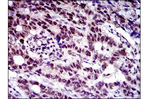Immunohistochemical analysis of paraffin-embedded esophageal cancer tissues using CFLAR mouse mAb with DAB staining. (FLIP anticorps  (AA 100-251))