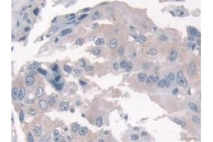 Detection of KLC1 in Human Breast cancer Tissue using Polyclonal Antibody to Kinesin Light Chain 1 (KLC1)