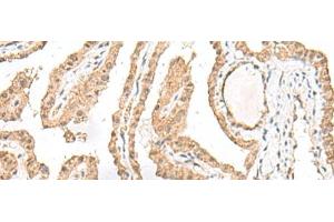 Immunohistochemistry of paraffin-embedded Human thyroid cancer tissue using RALGAPA1 Polyclonal Antibody at dilution of 1:55(x200)