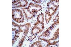 Immunohistochemical analysis of p53 staining in human colon cancer formalin fixed paraffin embedded tissue section.