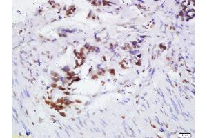 Formalin-fixed and paraffin embedded human colon cancer labeled with Rabbit Anti-OGG1 Polyclonal Antibody, Unconjugated 1:200 followed by conjugation to the secondary antibody and DAB staining