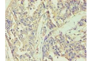 Immunohistochemistry of paraffin-embedded human endometrial cancer using ABIN7141988 at dilution of 1:100 (BCKDK anticorps  (AA 153-412))