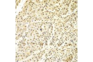 Immunohistochemistry of paraffin-embedded human liver cancer using Lamin A/C antibody.