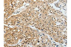 The image on the left is immunohistochemistry of paraffin-embedded Human lung cancer tissue using ABIN7193012(VEGFA Antibody) at dilution 1/25, on the right is treated with synthetic peptide. (VEGFA anticorps)