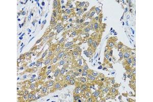 Immunohistochemistry of paraffin-embedded Human lung cancer using GOT1 Polyclonal Antibody at dilution of 1:100 (40x lens).