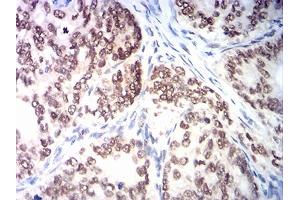 Immunohistochemical analysis of paraffin-embedded cervical cancer tissues using MSH2 mouse mAb with DAB staining.
