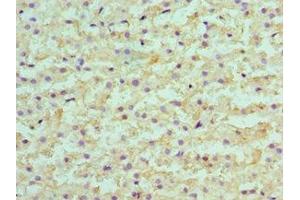 Immunohistochemistry of paraffin-embedded human liver cancer using ABIN7145594 at dilution of 1:100 (SULT2A1 anticorps  (AA 1-145))