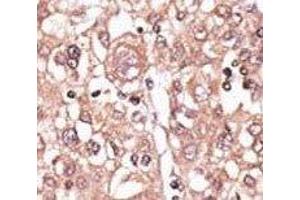 IHC analysis of FFPE human hepatocarcinoma tissue stained with the anti-TLR7 antibody (TLR7 anticorps  (AA 98-128))