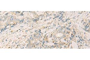 Immunohistochemistry of paraffin-embedded Human cervical cancer tissue using WDR37 Polyclonal Antibody at dilution of 1:50(x200) (WDR37 anticorps)