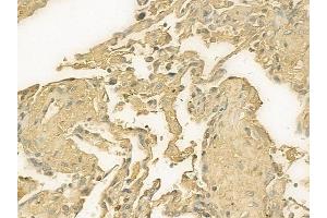 ABIN7093182 and ABIN7101266 at 1/100 staining human lung squamous cell carcinoma by IHC-P.
