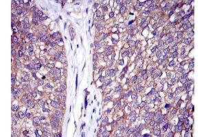Immunohistochemical analysis of paraffin-embedded bladder cancer tissues using C-CBL mouse mAb with DAB staining. (CBL anticorps)