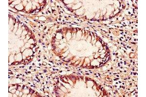Immunohistochemistry of paraffin-embedded human colon cancer using ABIN7172286 at dilution of 1:100 (TLR9 anticorps  (AA 425-563))