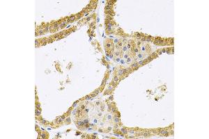 Immunohistochemistry of paraffin-embedded human thyroid cancer using FHL1 Antibody.