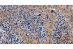 Immunohistochemistry of paraffin-embedded Human cervical cancer tissue using MAP3K13 Polyclonal Antibody at dilution 1:40 (MAP3K13 anticorps)