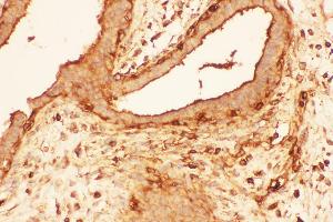 Anti-Cofilin Picoband antibody,  IHC(P): Human Mammary Cancer Tissue