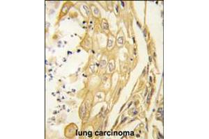 Formalin-fixed and paraffin-embedded human lung carcinoma tissue reacted with the EphB4 antibody , which was peroxidase-conjugated to the secondary antibody, followed by DAB staining. (EPH Receptor B4 anticorps)