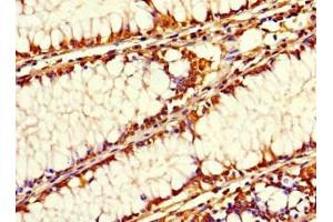 Immunohistochemistry of paraffin-embedded human colon cancer using ABIN7169707 at dilution of 1:100