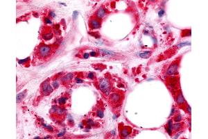 Anti-HUNK / B19 antibody IHC of human Breast, Carcinoma. (HUNK anticorps  (Kinase Domain))