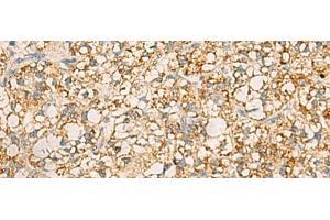 Immunohistochemistry of paraffin-embedded Human liver cancer tissue using PDCL Polyclonal Antibody at dilution of 1:40(x200)