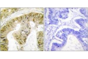 Immunohistochemistry analysis of paraffin-embedded human colon carcinoma, using FANCA (Phospho-Ser1149) Antibody.