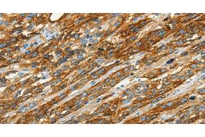 Immunohistochemistry of paraffin-embedded Human esophagus cancer using CAV1 Polyclonal Antibody at dilution of 1:40 (Caveolin-1 anticorps)