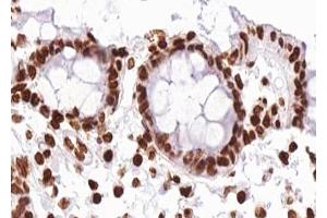 ABIN6267280 at 1/100 staining human Colon carcinoma tissue sections by IHC-P. (RAF1 anticorps  (pSer296))