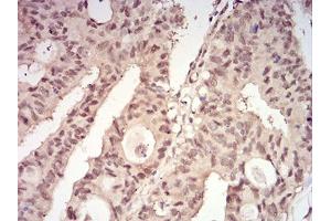 Immunohistochemical analysis of paraffin-embedded rectum cancer tissues using YWHAB mouse mAb with DAB staining. (YWHAB anticorps  (AA 1-246))
