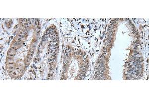 Immunohistochemistry of paraffin-embedded Human liver cancer tissue using UBA52 Polyclonal Antibody at dilution of 1:55(x200)