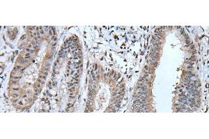 Immunohistochemistry of paraffin-embedded Human liver cancer tissue using UBA52 Polyclonal Antibody at dilution of 1:55(x200) (UBA52 anticorps)