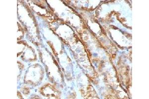 IHC testing of FFPE human renal cell carcinoma with Mitochondrial antibody (GFM1 anticorps)