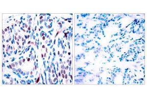 Immunohistochemical analysis of paraffin-embedded human breast carcinoma tissue using STAT3 (phospho-Tyr705) antibody (E011045). (STAT3 anticorps  (pTyr705))