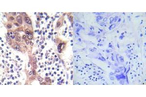 Immunohistochemical analysis of paraffin-embedded human breast carcinoma tissue using LKB1 (phospho- Ser428) antibody (E012046). (LKB1 anticorps  (pSer428))